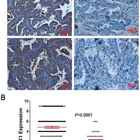 Expression Of Pak In Nsclc Tissues A Representative Ihc Staining Of