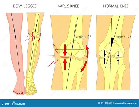 Shapes Of The Legsnormal And Curved Legsknock Kneesbowed Leg Stock