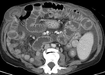 Imaging Of Bowel Obstruction Radiology Key