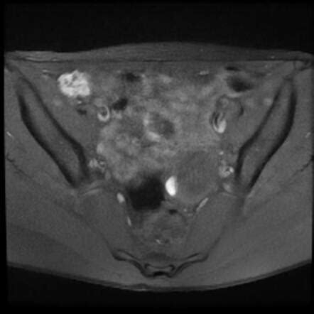 Ovarian Endometrioma With Ipsilateral Haemorrhagic Cyst Adolescent