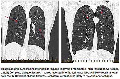 Bronchoscopic Procedures For Copd A Breath Of Fresh Air Respiratory