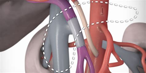 Total Pancreatectomy With Celiac Artery Reconstruction TVASurg The