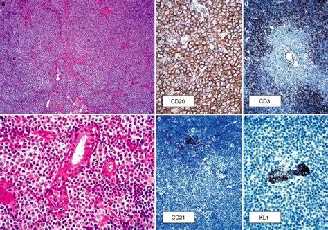 Marginal zone B-cell lymphoma in the breast. a,b, Morphology ...