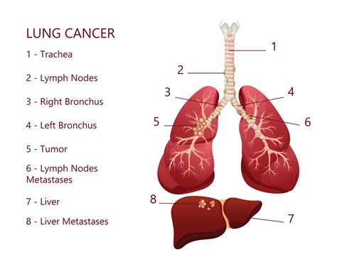 Lung Cancer Tumor Diagram