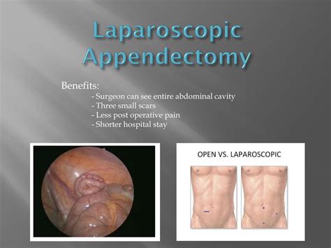 Ppt The “open” Versus Closed Appendectomy Powerpoint Presentation