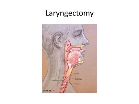 Tracheostomy Laryngectomy