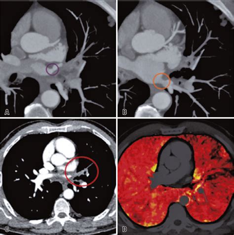 Scielo Brasil Stenosis Of The Left Pulmonary Veins After Atrial