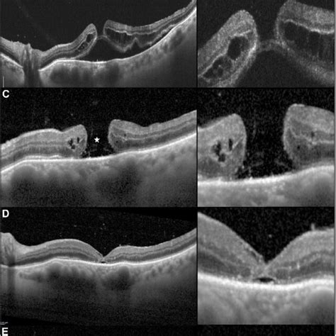 Lamellar Bacillary Layer Detachment Balad Associated With A