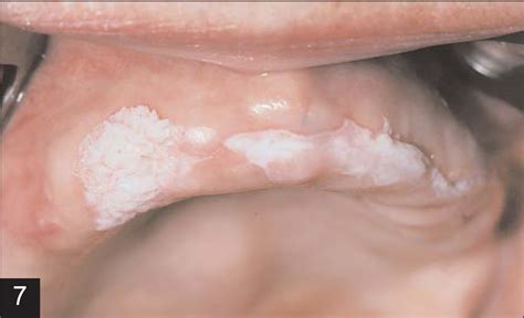 Oral Cancer And Precancerous Lesions Neville Ca A Cancer