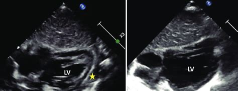 Echocardiography in subcostal long-axis view. (a) Pretreatment image ...