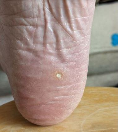 Painful White Spot On Bottom Of Foot Sale Online Emergencydentistry