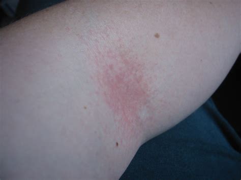 Itchy Bumps On Elbows Causes And Treatment - vrogue.co