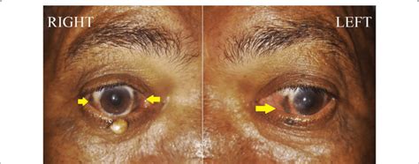 Clinical Image Of The Patient Eyes Showing A Blackish Discoloration Of