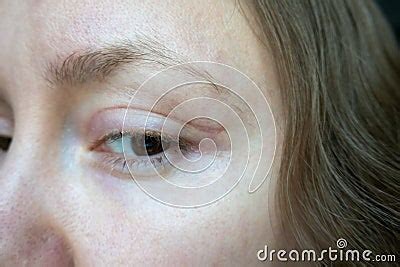 Woman Face After Plastic Surgery On Eyes Blepharoplasty Operation