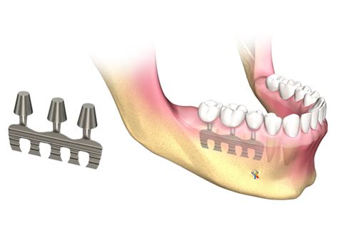 Dental Implant Types