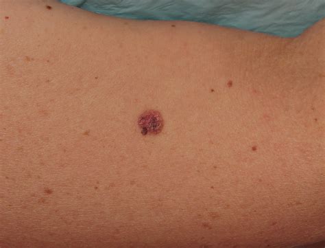 Melanoma On Leg