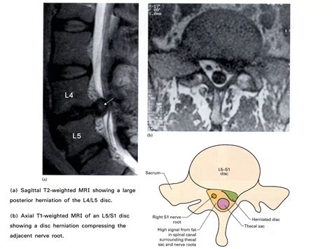 Applied Cross Sectional Anatomy Of Spinal Cord Ppt