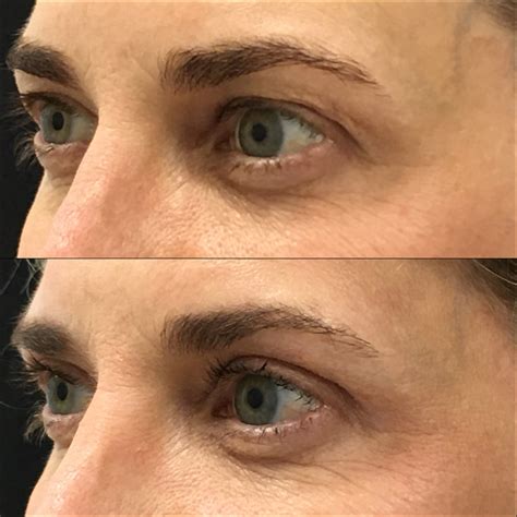 Upper Blepharoplasty Before After Photos Flora Levin Md