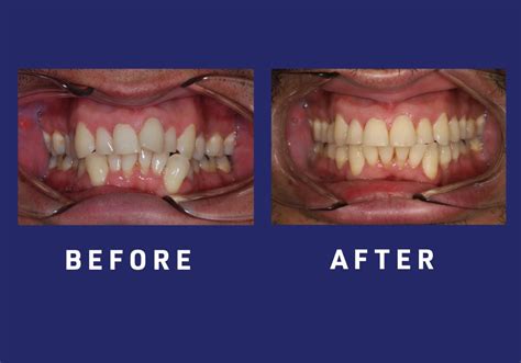 Before And After Gallery Sapphire Denture