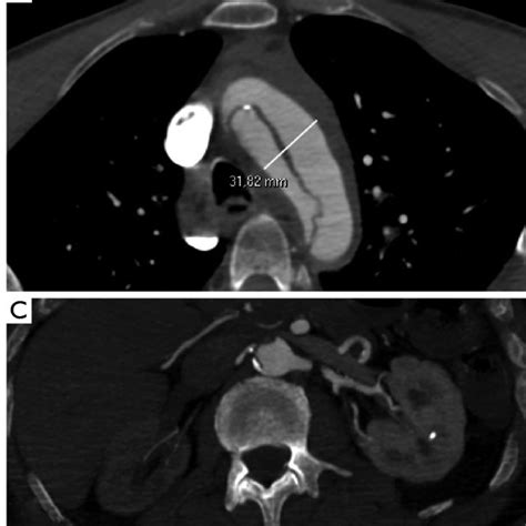 Aortic Dissection On Ct Scan Ct Scan Machine Images