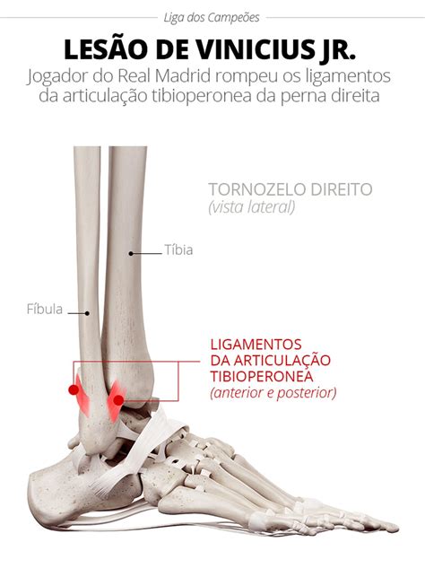 Vinicius Junior Rompe Ligamentos Do Tornozelo E Deve Ser Cortado Da