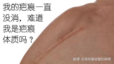 医生告诉你：你到底是不是“疤痕体质”？ 知乎