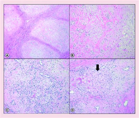 Pathologic Findings Of Hepatic Mesenchymal Hamartoma Hepatic