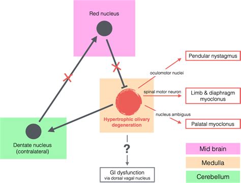 Hypertrophic Olivary Degeneration Pathway Proposed Mechanism For