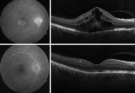 Branch Retinal Vein Occlusion Oct