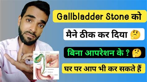 Gall Bladder Stone Treatment In Hindi YouTube