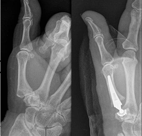 Pre And Post Operative Radiographs Download Scientific Diagram