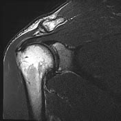 Distal clavicle osteolysis | Radiology Reference Article | Radiopaedia.org