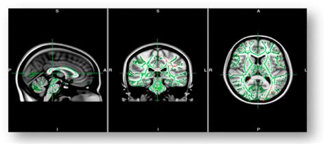 Figure 1 From White Matter Microstructure In Ultra High Risk And First