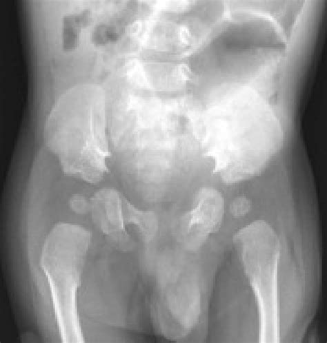 X Ray Pelvis Showing Small Square Iliac Crest With Spikes Of Bone At