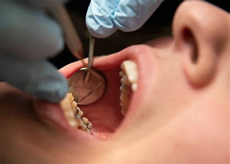 Different Types Of Dental Fillings And Their Pros And Cons Smilescare Dental Education