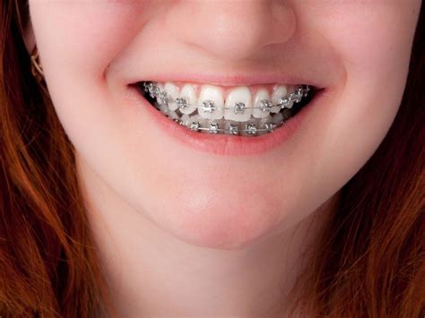 Does Your Child Really Need Braces: Weighing the Options