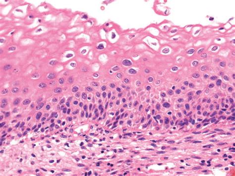 Precancerous Squamous Cell Skin Cancer