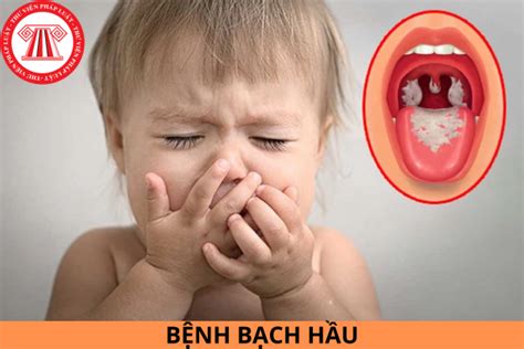 Bệnh bạch hầu là bệnh gì Nguyên nhân triệu chứng và cách phòng ngừa