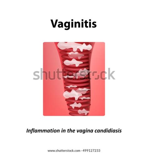 Vaginitis Inflammation Vagina Candidiasis Thrush Infographics Stock