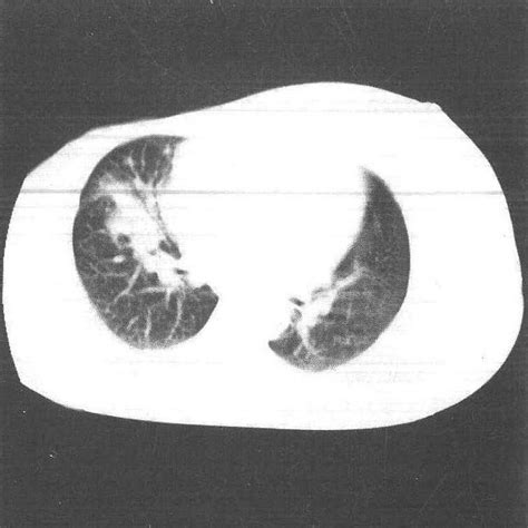 第五节 放射性肺炎 胸部ct诊断图谱 医学