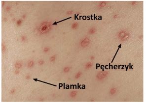 Choroby Wirusowe Hsv Opryszczka Ospa Wietrzna P Pasiec Brodawki