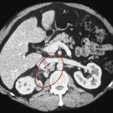 Portacaval Lymph Nodes