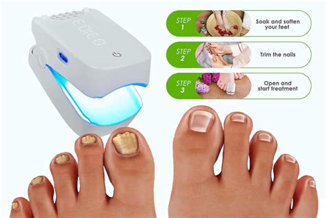 Fungal Nail Laser Device With Usb Cable Offer Nail Fungus Removal