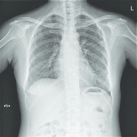 Chest Radiography Prior To Discharge Chest Radiography Was Performed