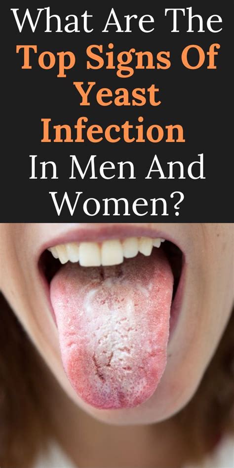 What Are The Top Signs Of Yeast Infection In Men And Women