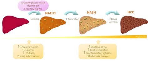 Progression Of Non Alcoholic Fatty Liver Disease Nafld To Download Scientific Diagram