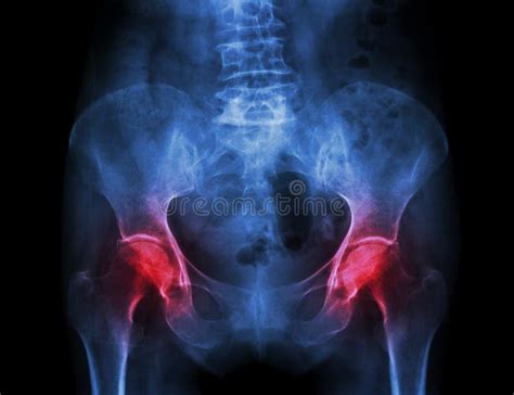 1 728 Human Pelvis Stock Photos Free Royalty Free Stock Photos From