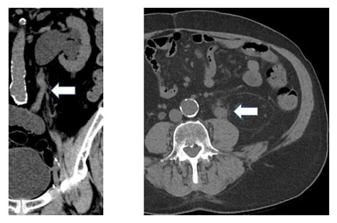 Management Of Upper Tract Urothelial Carcinoma After Radical Cystectomy