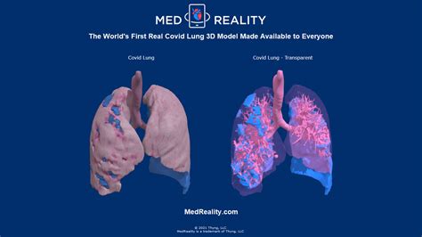 Medreality Releases Covid Lung Model Medreality