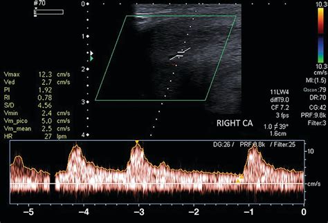 Penile Doppler Ultrasound For Erectile Dysfunction Technique And